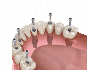 All on 4 Dental Implant